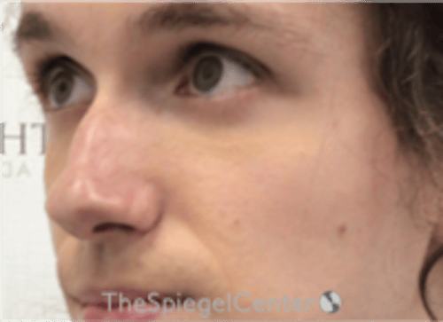 Cheek Implants Before & After Gallery - Patient 217656 - Image 1