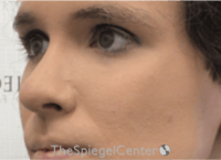 Cheek Implants Before & After Gallery - Patient 217656 - Image 2