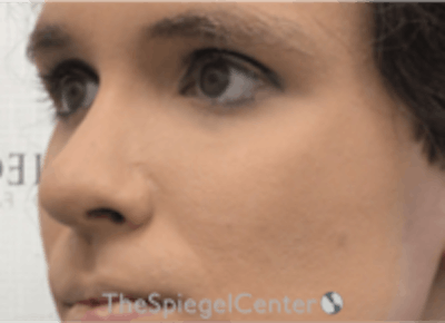 Cheek Implants Before & After Gallery - Patient 217656 - Image 2