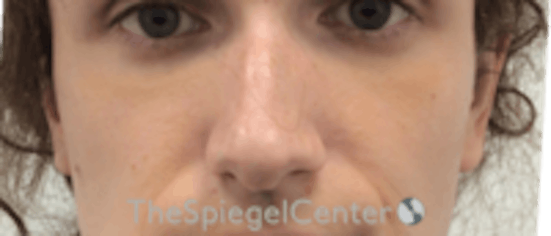 Cheek Implants Before & After Gallery - Patient 217656 - Image 3