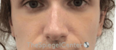 Cheek Implants Before & After Gallery - Patient 217656 - Image 3