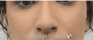 Cheek Implants Before & After Gallery - Patient 217656 - Image 4