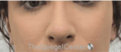 Cheek Implants Before & After Gallery - Patient 217656 - Image 4