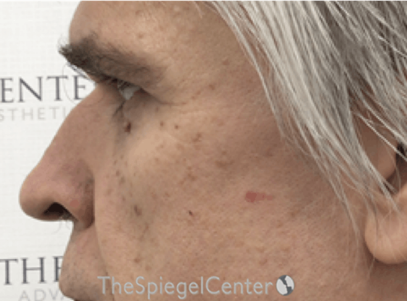 Cheek Implants Before & After Gallery - Patient 397846 - Image 1