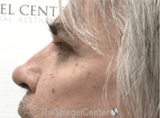 Cheek Implants Before & After Gallery - Patient 397846 - Image 2