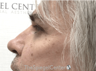 Cheek Implants Before & After Gallery - Patient 397846 - Image 2