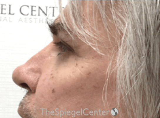 Cheek Implants Before & After Gallery - Patient 397846 - Image 2