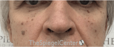 Cheek Implants Before & After Gallery - Patient 397846 - Image 3