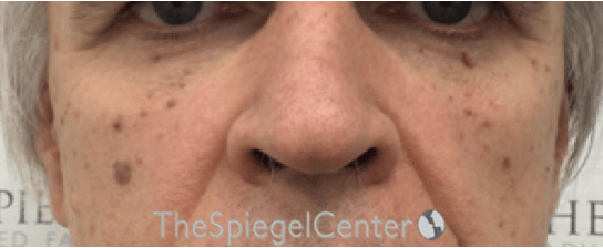 Cheek Implants Before & After Gallery - Patient 397846 - Image 3