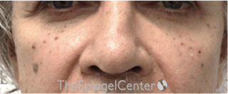Cheek Implants Before & After Gallery - Patient 397846 - Image 4