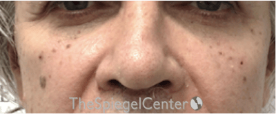 Cheek Implants Before & After Gallery - Patient 397846 - Image 4
