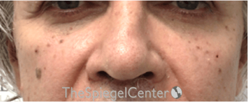 Cheek Implants Before & After Gallery - Patient 397846 - Image 4