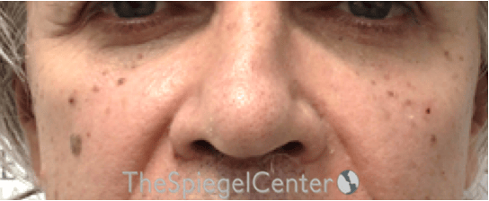 Cheek Implants Before & After Gallery - Patient 397846 - Image 4