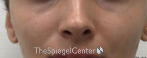Cheek Implants Before & After Gallery - Patient 273797 - Image 1