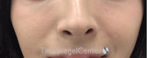 Cheek Implants Before & After Gallery - Patient 273797 - Image 2