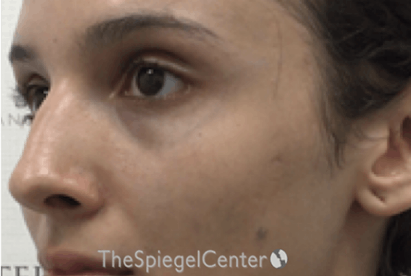 Cheek Implants Before & After Gallery - Patient 273797 - Image 3