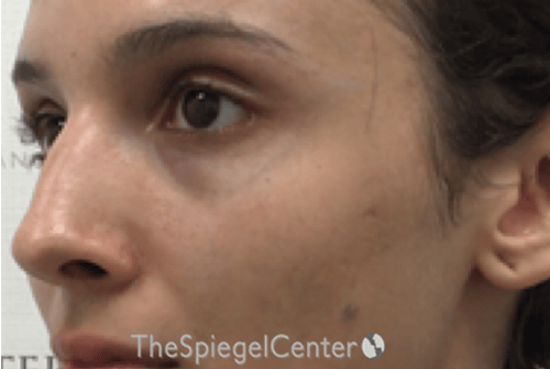 Cheek Implants Before & After Gallery - Patient 273797 - Image 3