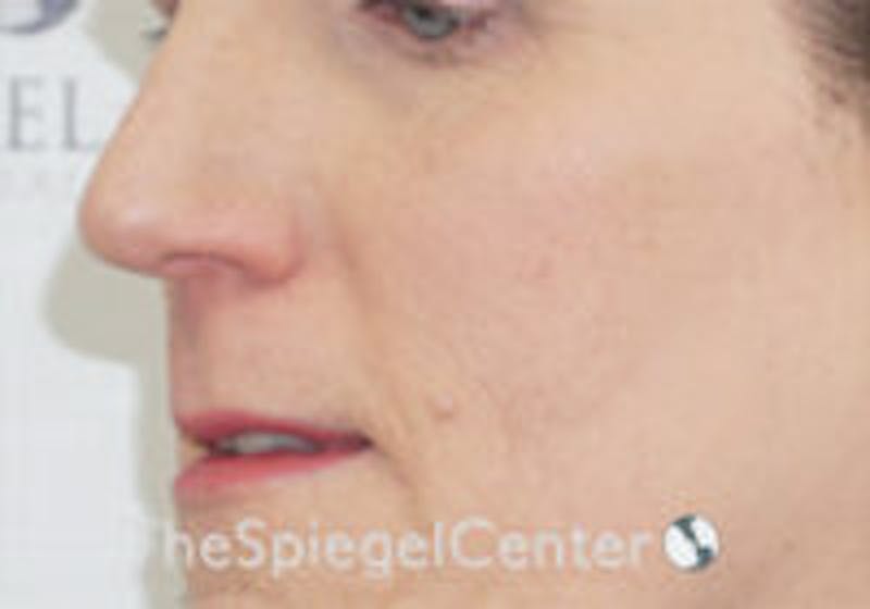 Cheek Implants Before & After Gallery - Patient 295978 - Image 1