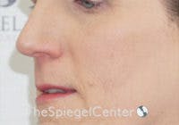 Cheek Implants Before & After Gallery - Patient 295978 - Image 1
