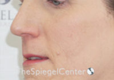 Cheek Implants Before & After Gallery - Patient 295978 - Image 1