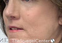 Cheek Implants Before & After Gallery - Patient 295978 - Image 2