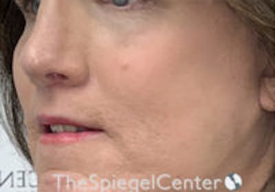 Cheek Implants Before & After Gallery - Patient 295978 - Image 2