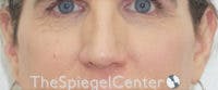 Cheek Implants Before & After Gallery - Patient 295978 - Image 3
