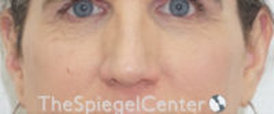 Cheek Implants Before & After Gallery - Patient 295978 - Image 3