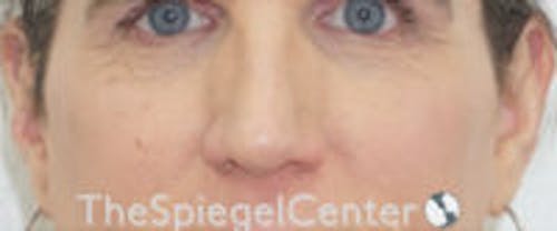 Cheek Implants Before & After Gallery - Patient 295978 - Image 3
