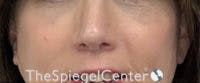 Cheek Implants Before & After Gallery - Patient 295978 - Image 4