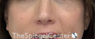 Cheek Implants Before & After Gallery - Patient 295978 - Image 4