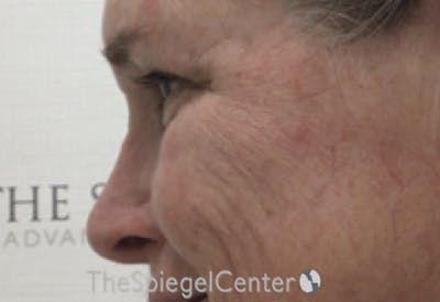 Cheek Implants Before & After Gallery - Patient 230299 - Image 1