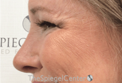 Cheek Implants Before & After Gallery - Patient 230299 - Image 2