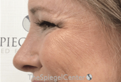 Cheek Implants Before & After Gallery - Patient 230299 - Image 2