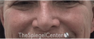 Cheek Implants Before & After Gallery - Patient 230299 - Image 3