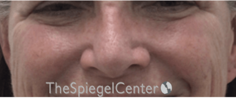 Cheek Implants Before & After Gallery - Patient 230299 - Image 3