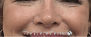 Cheek Implants Before & After Gallery - Patient 230299 - Image 4