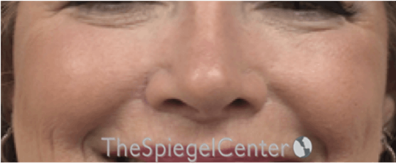 Cheek Implants Before & After Gallery - Patient 230299 - Image 4