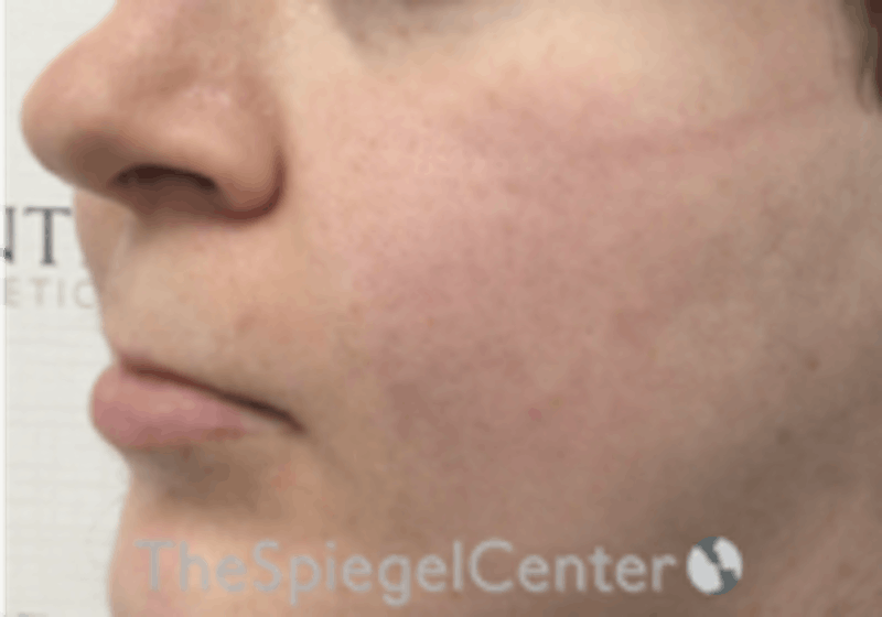 Cheek Implants Before & After Gallery - Patient 132756 - Image 1