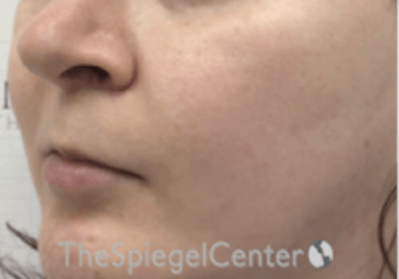 Cheek Implants Before & After Gallery - Patient 132756 - Image 2
