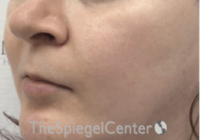 Cheek Implants Before & After Gallery - Patient 132756 - Image 2