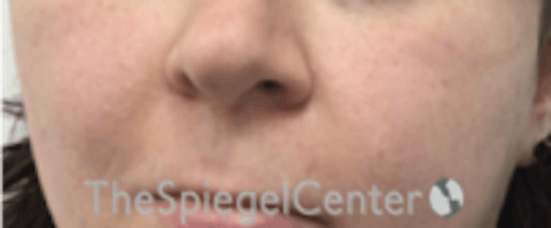 Cheek Implants Before & After Gallery - Patient 132756 - Image 3