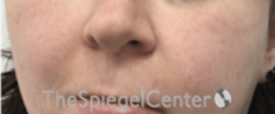 Cheek Implants Before & After Gallery - Patient 132756 - Image 3