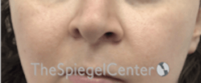 Cheek Implants Before & After Gallery - Patient 132756 - Image 4