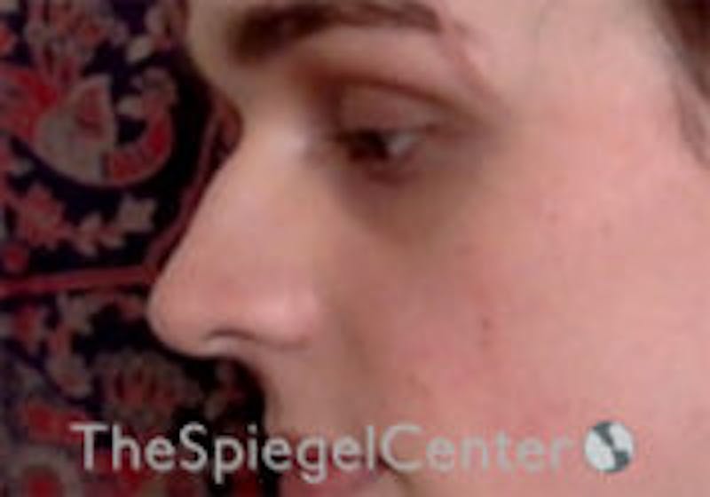 Cheek Implants Before & After Gallery - Patient 417913 - Image 1