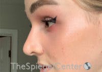 Cheek Implants Before & After Gallery - Patient 417913 - Image 2