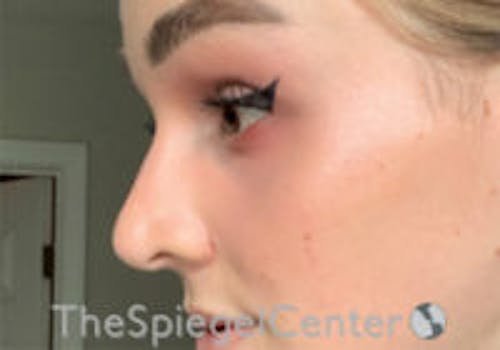 Cheek Implants Before & After Gallery - Patient 417913 - Image 2