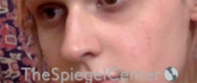 Cheek Implants Before & After Gallery - Patient 417913 - Image 3