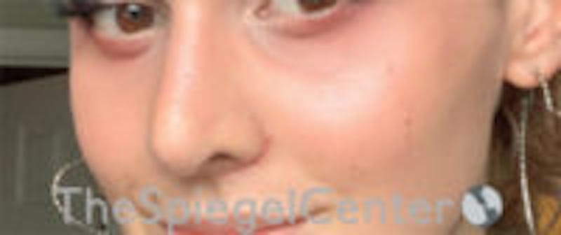 Cheek Implants Before & After Gallery - Patient 417913 - Image 4