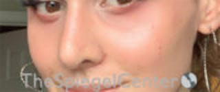 Cheek Implants Before & After Gallery - Patient 417913 - Image 4